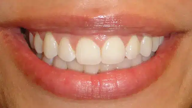 Close-up of a person's smile showing white, straight teeth and pink lips after orthodontic treatment.
