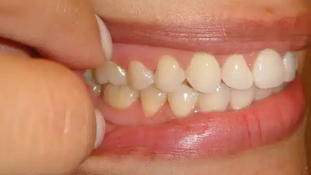 Close-up of smile showing teeth alignment and orthodontic results with finger pointing to upper teeth.