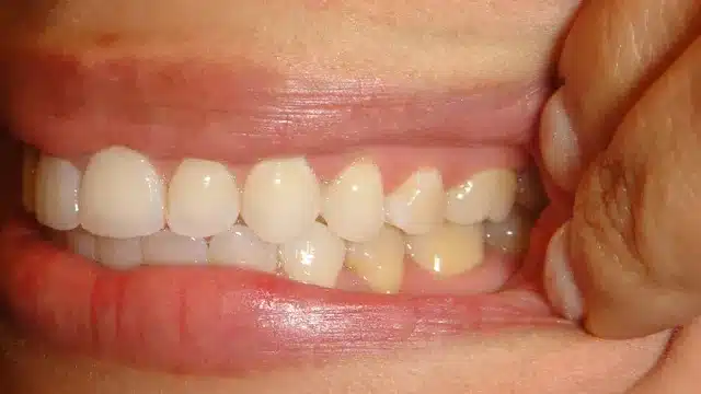 Close-up of patient's teeth showing dental alignment and bite correction during orthodontic treatment.