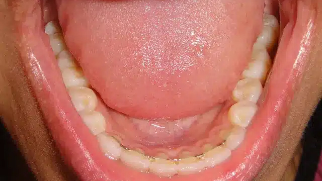 Open mouth showing lower teeth with orthodontic braces during dental examination.
