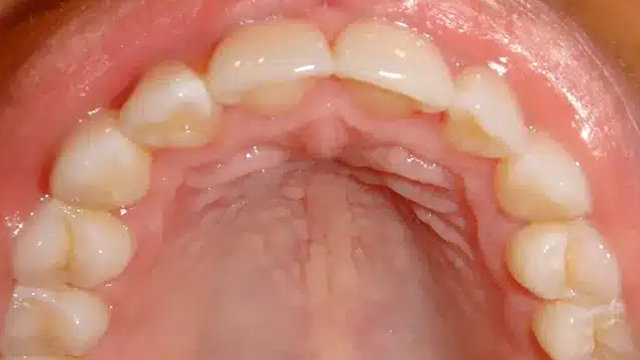 Close-up intraoral view of upper dental arch showing teeth alignment and palate structure.