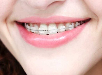 Close-up of smiling person displaying straight white teeth with orthodontic braces.