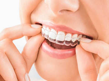 Person inserting clear orthodontic aligner into mouth, demonstrating invisible braces treatment.