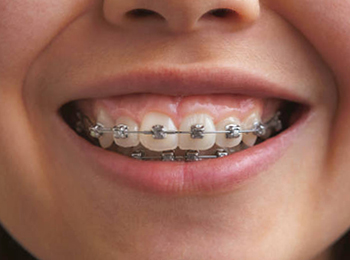 Close-up of smiling mouth showing metal braces on upper and lower teeth.